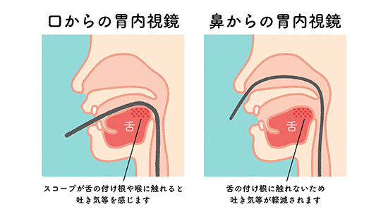 苦痛を軽減した上部消化管内視鏡検査（経鼻内視鏡検査）